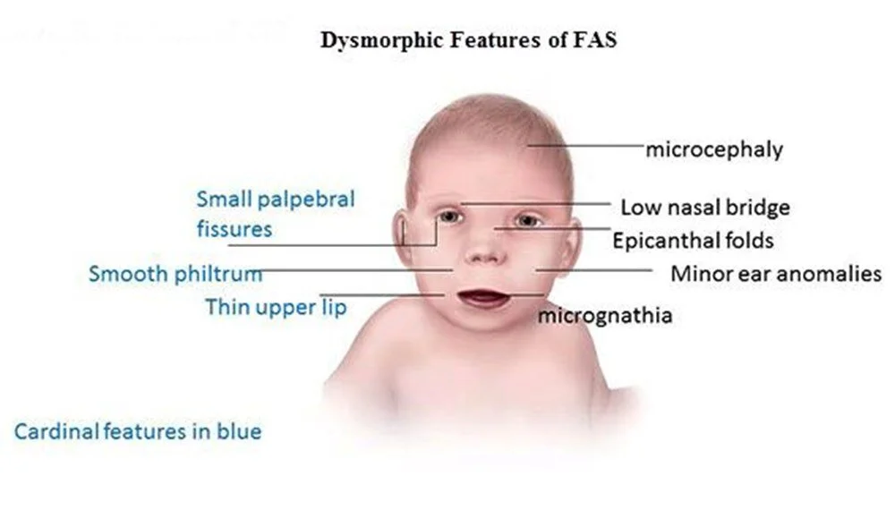 Warning to expectant mothers Alcohol consumption before pregnancy causes babies faces to change 1